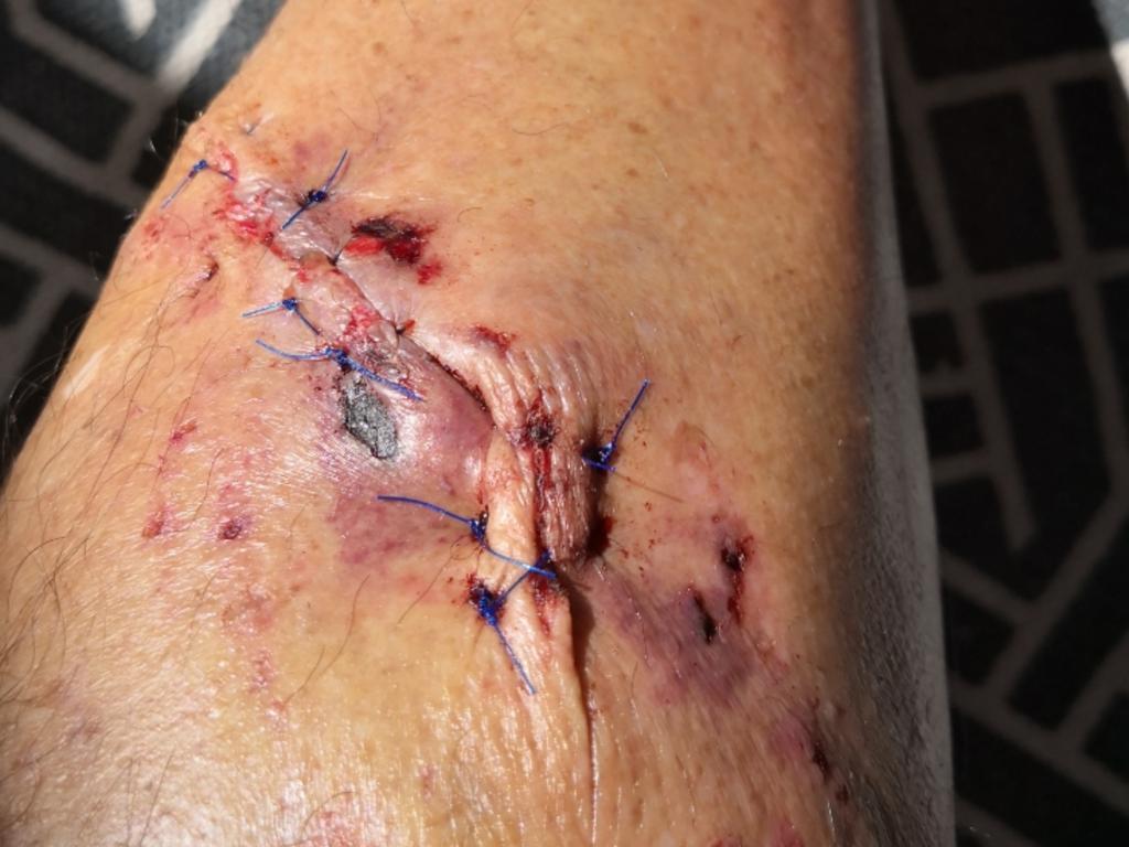 A postie's injuries after being attacked by a dog. Picture: Supplied/Australia Post