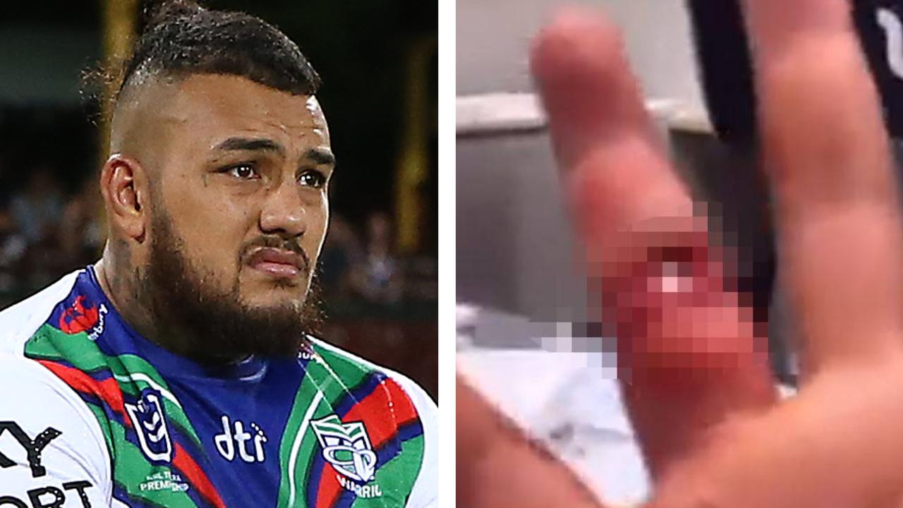 Warriors Star Shares Video Of Gruesome Finger Injury Casualty Ward   A74ef96abe5f2de2eaa3429917d35464