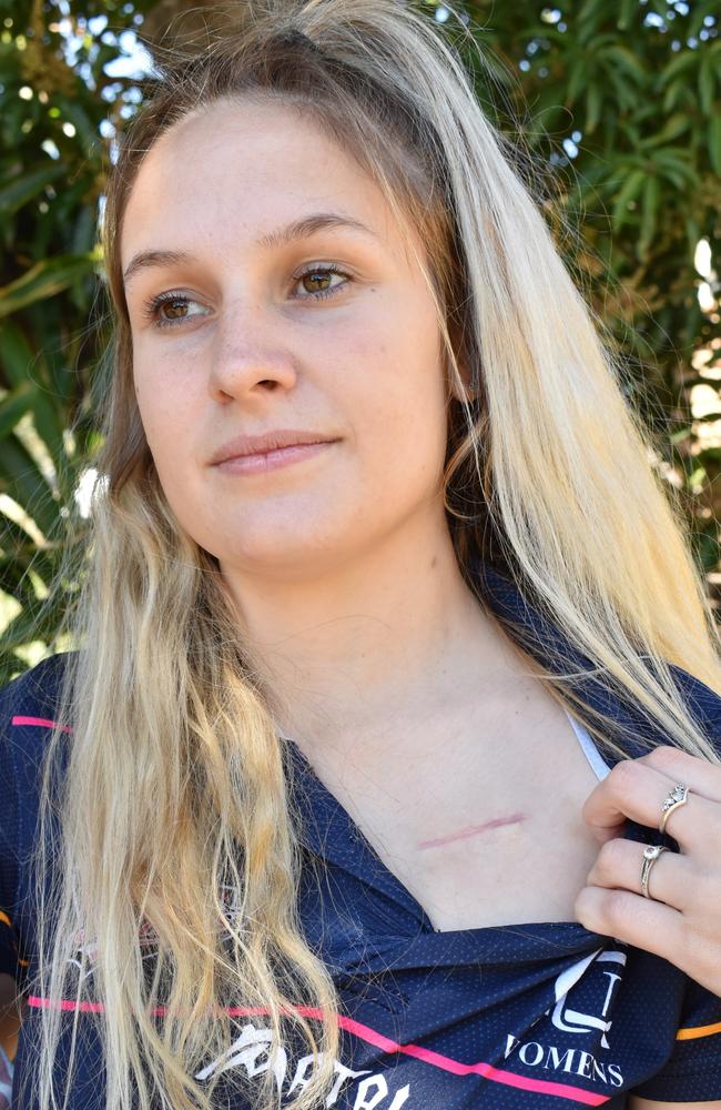 Jess Allen shows where the implantable cardioverter-defibrillator was placed in her chest.