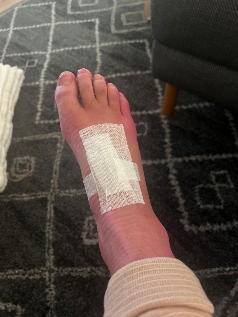 Hodgson’s foot post-surgery. Picture: Supplied
