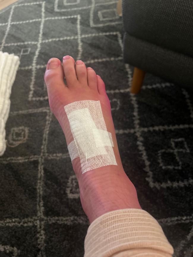 Hodgson’s foot post-surgery. Picture: Supplied