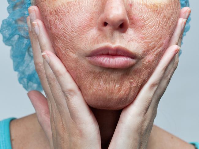 Women are buying chemical peel products off eBay.