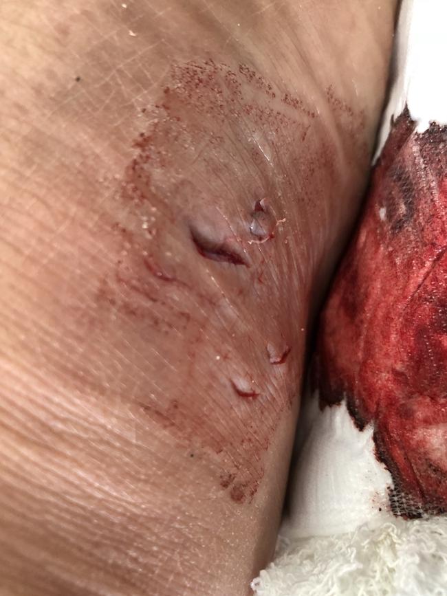 Mike Ruttkowski’s foot following the bite. Picture: Jim O'Rourke