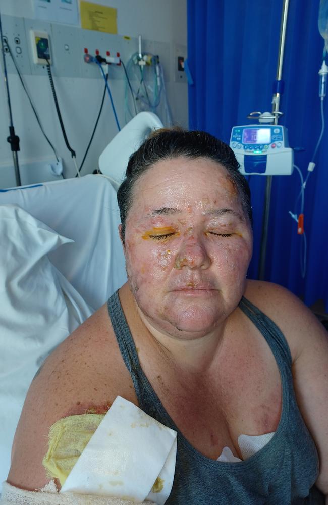 Markeeta Harwood in hospital receiving treatment for her burns. Picture: Supplied.