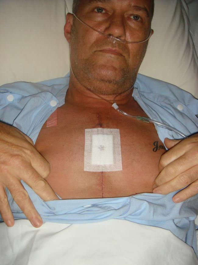 Jimmy Barnes after open heart surgery in 2007.