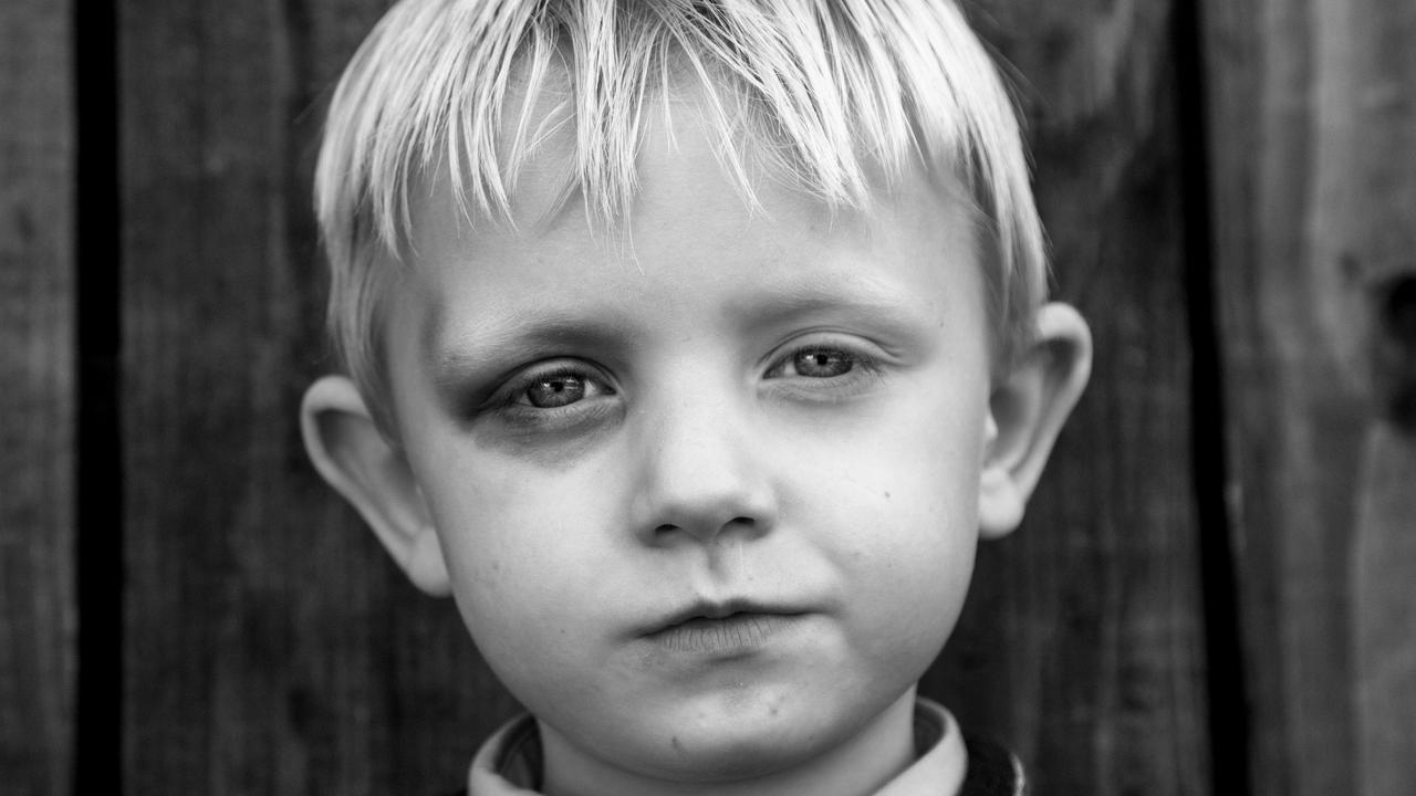 A young boy poses with a black eye. Picture: Jamie Johnson