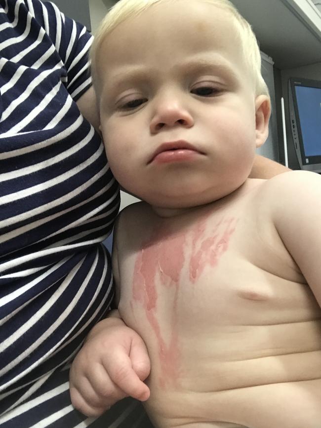 Beau was 15 months old when he suffered dermal burning due to boiling water spilling on his chest.