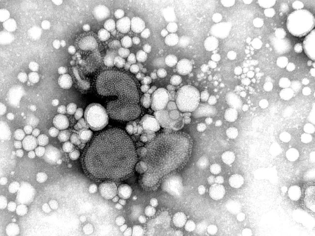 The child contracted the avian influenza A infection while in India and fell ill in March this year, according to Victorian health officials.