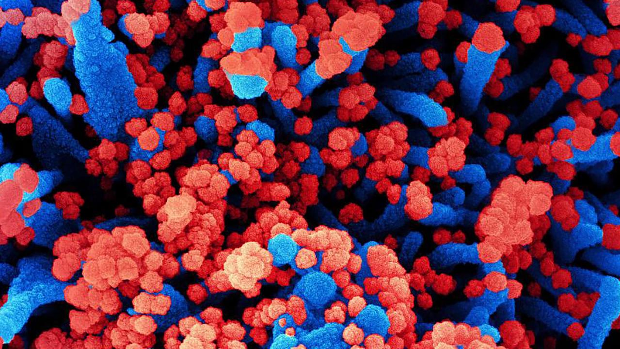 A colorised scanning electron micrograph of a cell (blue) heavily infected with SARS-CoV-2 virus particles (red). Picture: National Institute of Allergy and Infectious Diseases/AFP