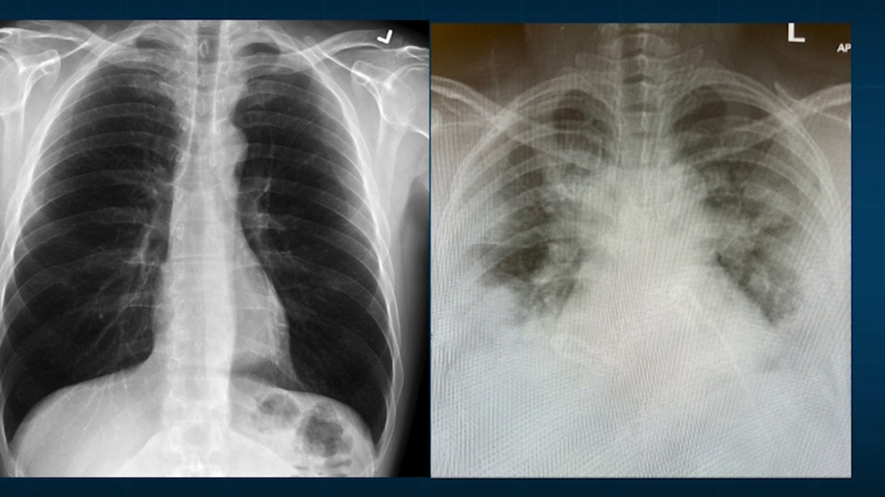 These side-by-side comparison X-rays show the lungs of a healthy person on the left, and those of a person with COVID in their 30s, experiencing significant fluid build-up.