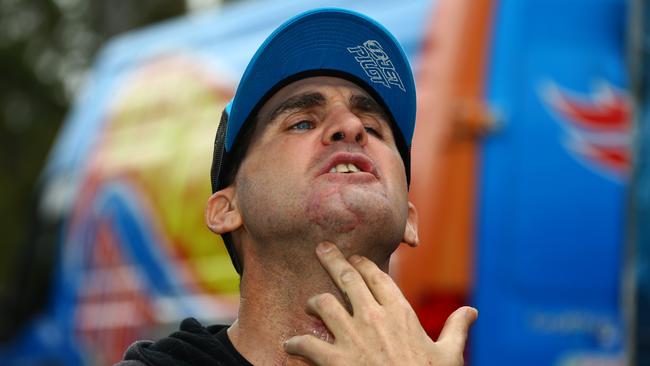 Stunt driver Matt Mingay shows his scars. Picture: David Clark