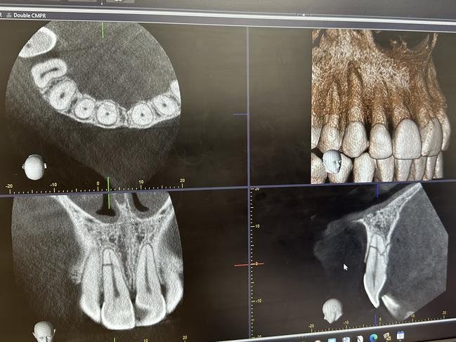 X-ray imagery of Alice Kunek's broken teeth.