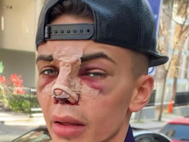 Levi wants to show his followers the full extent of what surgery entails, even if it is not pretty. MANCHESTER, UK: MEET THE man who spent THIRTY-THOUSAND POUNDS on plastic surgery to look like an Instagram filter - but now receives thousands of DMs comparing him to the mask from The Purge. Social media influencer Levi Jed Murphy (24) from Manchester, UK, left school at 16 and started making comedy videos on Facebook, amassing over 700,000 followers in the process. With the popularity of these videos dying down in following years, Levi found himself stuck in a retail job that he hated. Meeting his boyfriend, Cameron Smith (25), the pair started selling explicit images and videos together for their OnlyFans page and Levi soon realised that he was able to make over ten times the amount of money from this x-rated content, compared to his nine to five job. Bringing in over Â£10,000 per month, Levi turned to cosmetic procedures to enhance his look. After getting his first injection of lip filler, aged 19, Levi loved how it looked and went back for more just a month later. Creating videos about his plastic surgery adventures, Levi?s shot to stardom on both TikTok and Instagram, gaining a combined total of over 2.5 million followers across both of these platforms. As a result his OnlyFans continued to grow and now makes up to Â£30,000 per month. By the time he was 20, Levi was having frequent injections of filler in his lips, cheeks, chin, jaw, and under his eyes. In 2019, Levi travelled to Turkey to undergo a nose job and lip lift in which skin is removed from under the nose to bring the lips higher up. In total, Levi has spent over Â£30,000 on cosmetic and surgical procedures to achieve his plastic-fantastic look, with his nose jobs and lip lifts costing Â£16,000, fillers coming to Â£10,000 and teeth straightening procedure totalling Â£2,000. In late 2019, Levi came across an Instagram filter which showed users what they would look like if they were to have plastic surgery. In