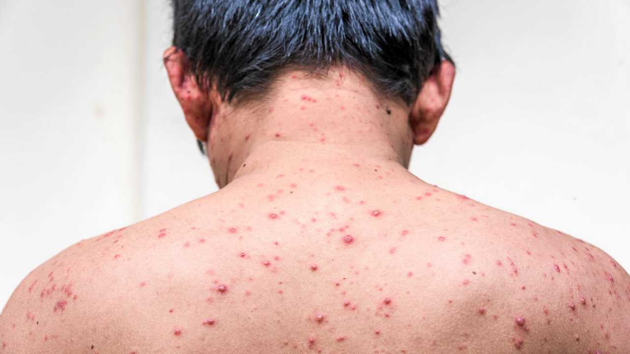 Back side of a man who having varicella blister or chickenpox ,isolated on white. Picture: viiwee