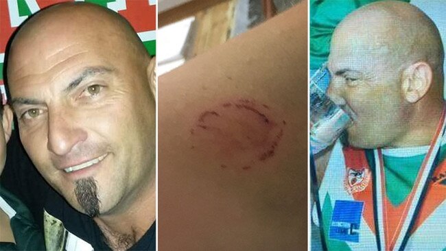 Virginia Rams B-Grade footballer Ricky Russo and, inset, the injury he caused by biting an opponent in 2018. Russo received a life ban in 2019 after biting another player in his first game back from suspension. Pictures supplied and from Facebook.