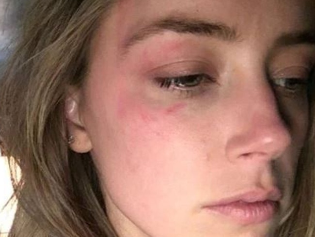 Amber Heard bruised after alleged abuse by Johnny Depp. Picture: Supplied