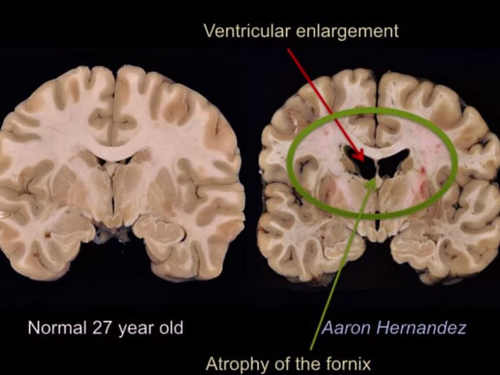 Hernandez’s brain had major damage.