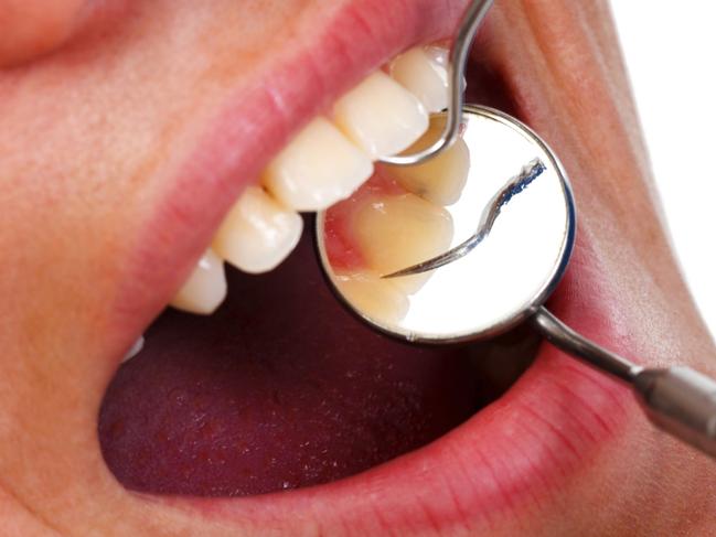 Generic image of dentist working on teeth with mirror.