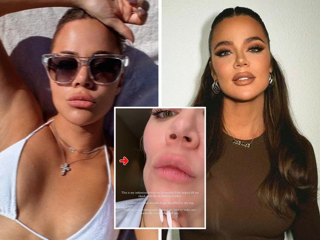 Khloe Kardashian has shocked fans with before-and-after photos following the removal of a skin cancer from her cheek. Picture: Supplied