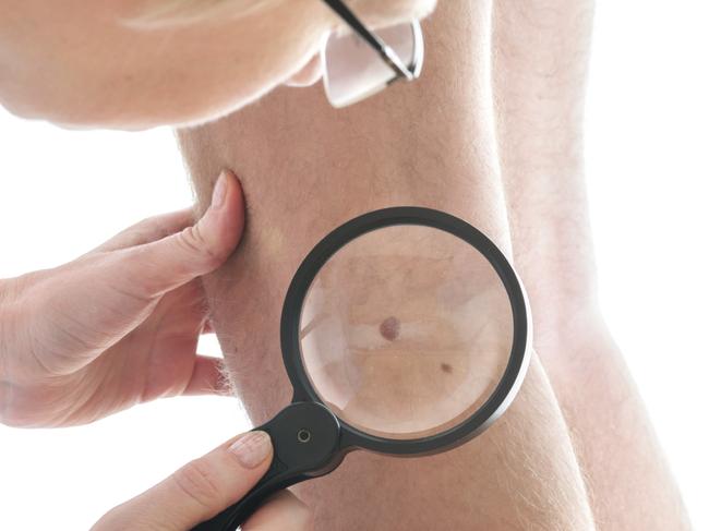 Australia has the highest melanoma rates in the world.