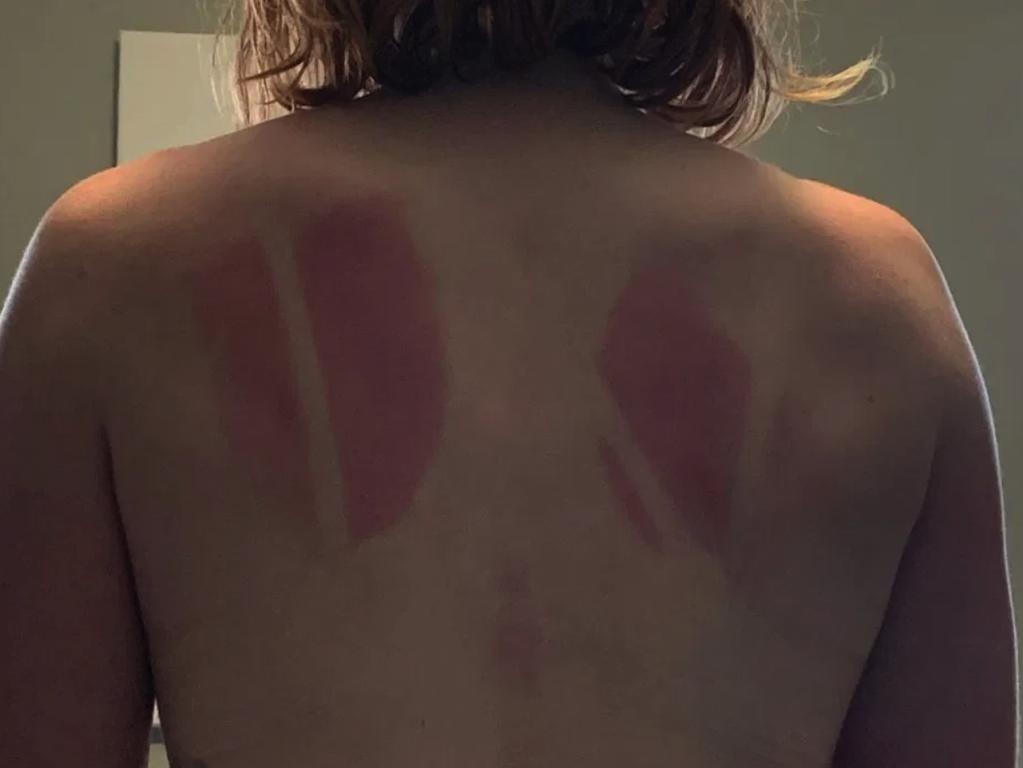 Note to self: Always apply suncream on your back. Picture: Instagram