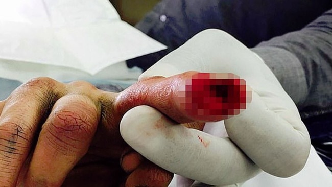 Depp’s severed right finger.