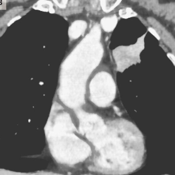 A CT scan of the woman's chest, pictured, revealed abnormalities in her lungs – later diagnosed as cancer. Picture: Credit: The New England Journal of Medicine