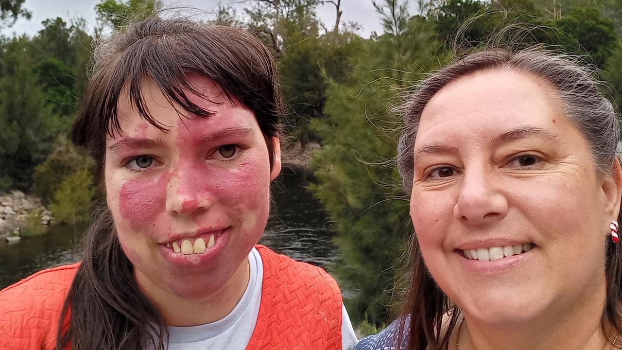 Jenny Best with daughter Ashlee, 26, who was born with a rare congenital neurological and skin disorder.