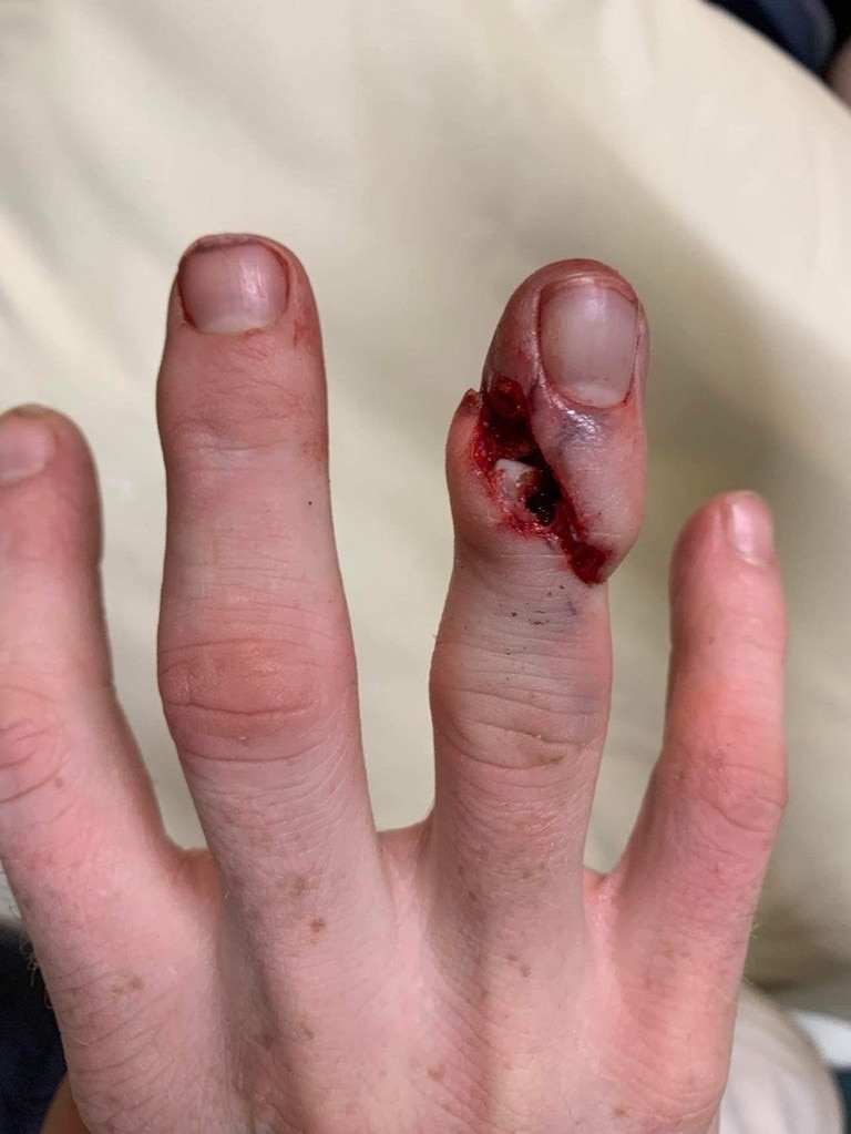 WARNING GRAPHIC IMAGE Hockeyroo Matt Dawson’s gruesome finger photos after being hit by a hockey stick in a practice match only weeks out from Paris.