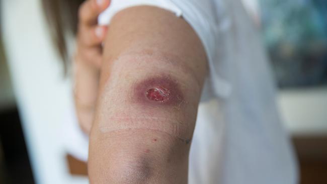 Health authorities have warned Victorians to take extra precautions following a record number of Buruli ulcer cases across the state. Picture: Paul Jeffers