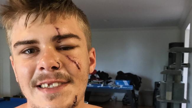 McKenzie Weir with his scars after surgery.