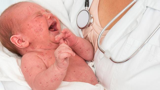 Measles has reached epidemic status in New Zealand this year with more than 1800 cases recorded, many in the Auckland region. Picture: istock