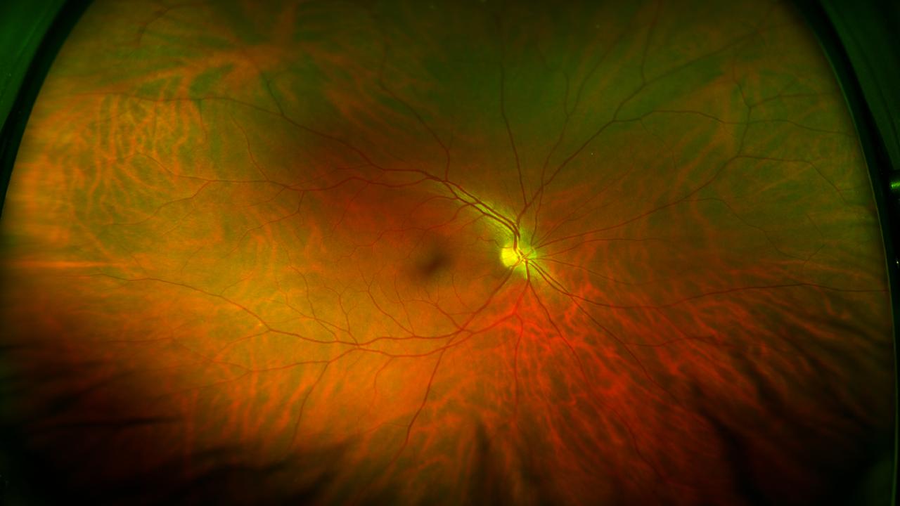 This is what a normal, healthy retina looks like.