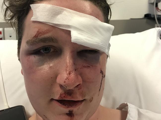 James Beange, 18 received massive facial injuries when assaulted at a bus stop at Mona Vale early on New Year's Day.