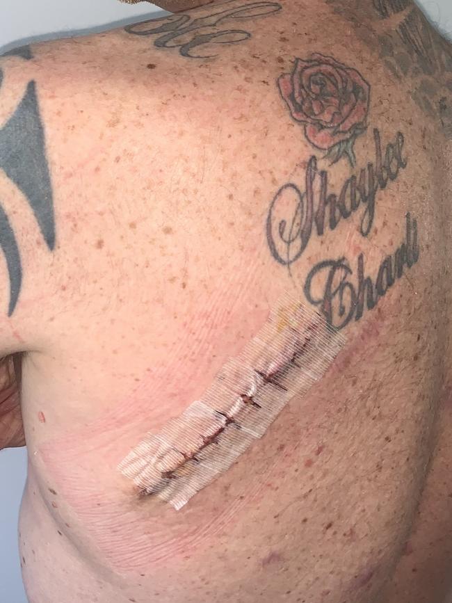 Jay Allen had another melanoma cut out off his back. Picture: Supplied