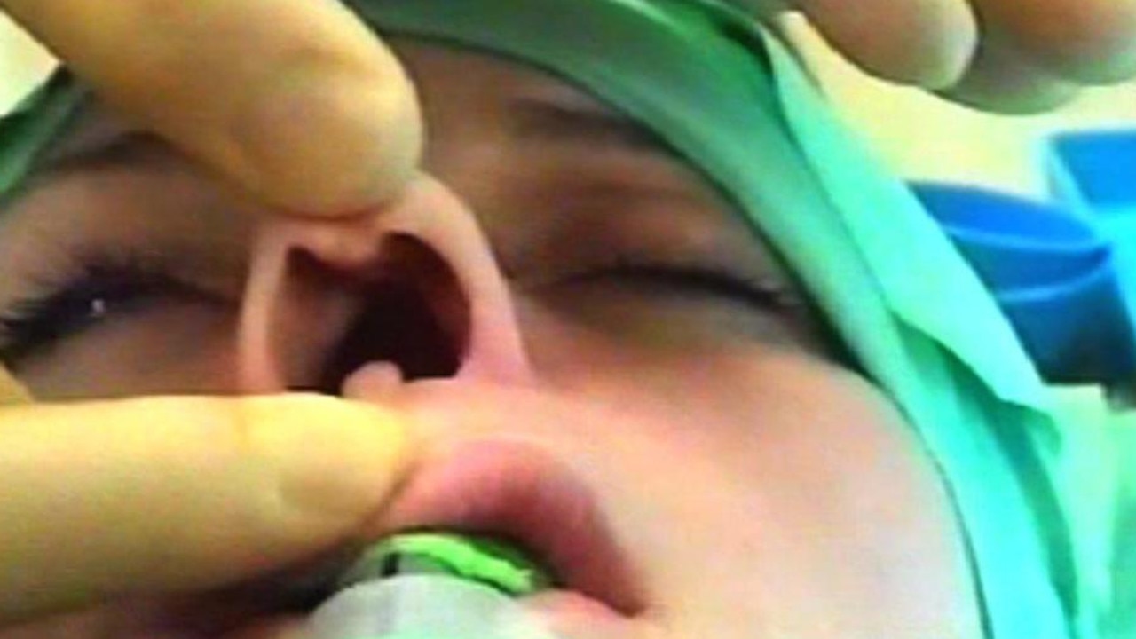 Danniella in surgery to repair her nose. Picture: Supplied