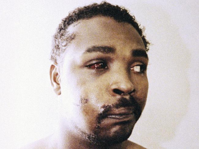 Rodney King, three days after his videotaped beating in Los Angeles March 1991.