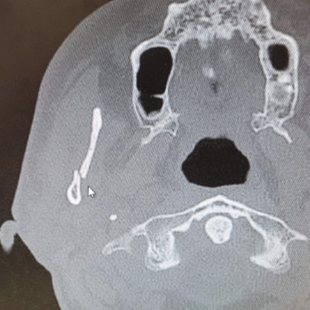 An X-ray image of Mr Gibbs’ broken jaw. Picture: supplied