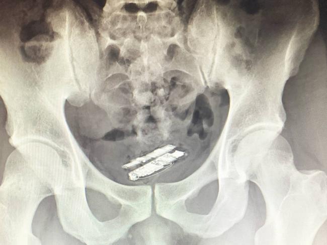 An X-ray showing a mobile phone hidden up an inmate’s bottom. Picture: Corrective Services NSW