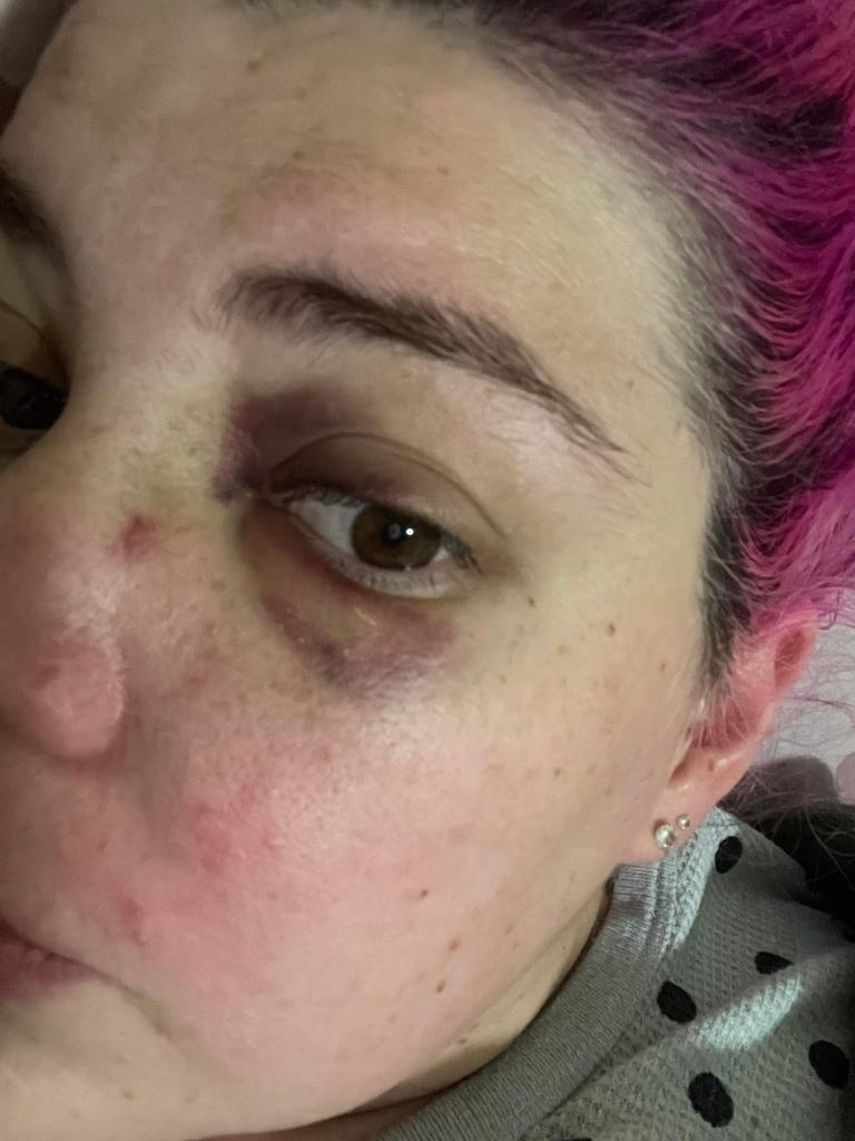 She suffered a broken nose, significant bruising and swollen eyes. Picture: Supplied