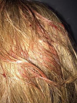 Abby Mullen’s blood soaked hair.