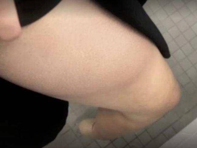 Ms Higgins’ bruise photograph that was provided to The Project. Picture: Seven News Spotlight