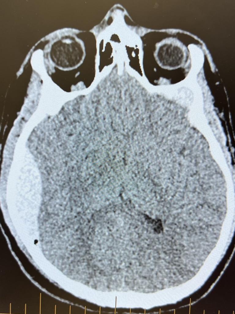 An X-ray shows Harry Froling's brain injuries.