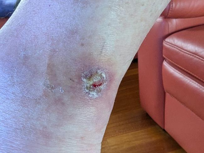 Geoffrey Mutton's healing ulcer. Picture: Supplied