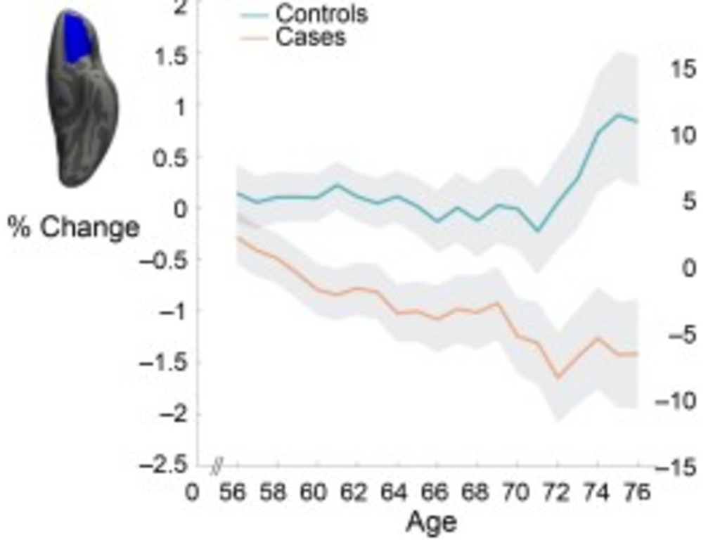 Scans demonstrate a significantly greater reduction in grey matter thickness and intensity. The area of interest is shown in blue and depicts a decrease in grey matter thickness. The orange graph line indicates grey matter thickness shown in scans of Covid patients. The blue line shows the thickness of people had not had Covid. Picture: Supplied.