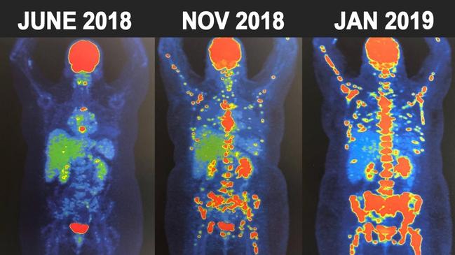 Scans show how rapidly cancer has spread through her body. Photo: Supplied