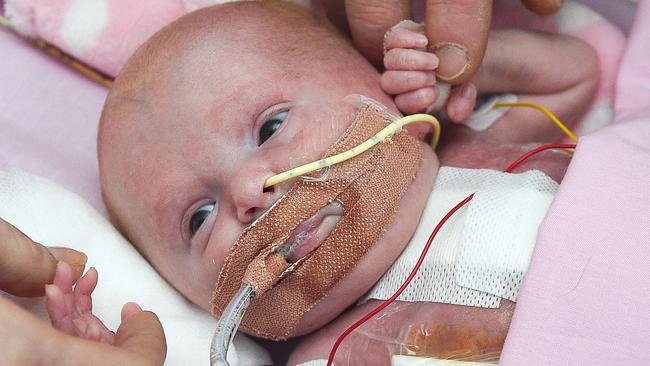 Baby Born With Heart Outside Her Body Survives Surgery Au