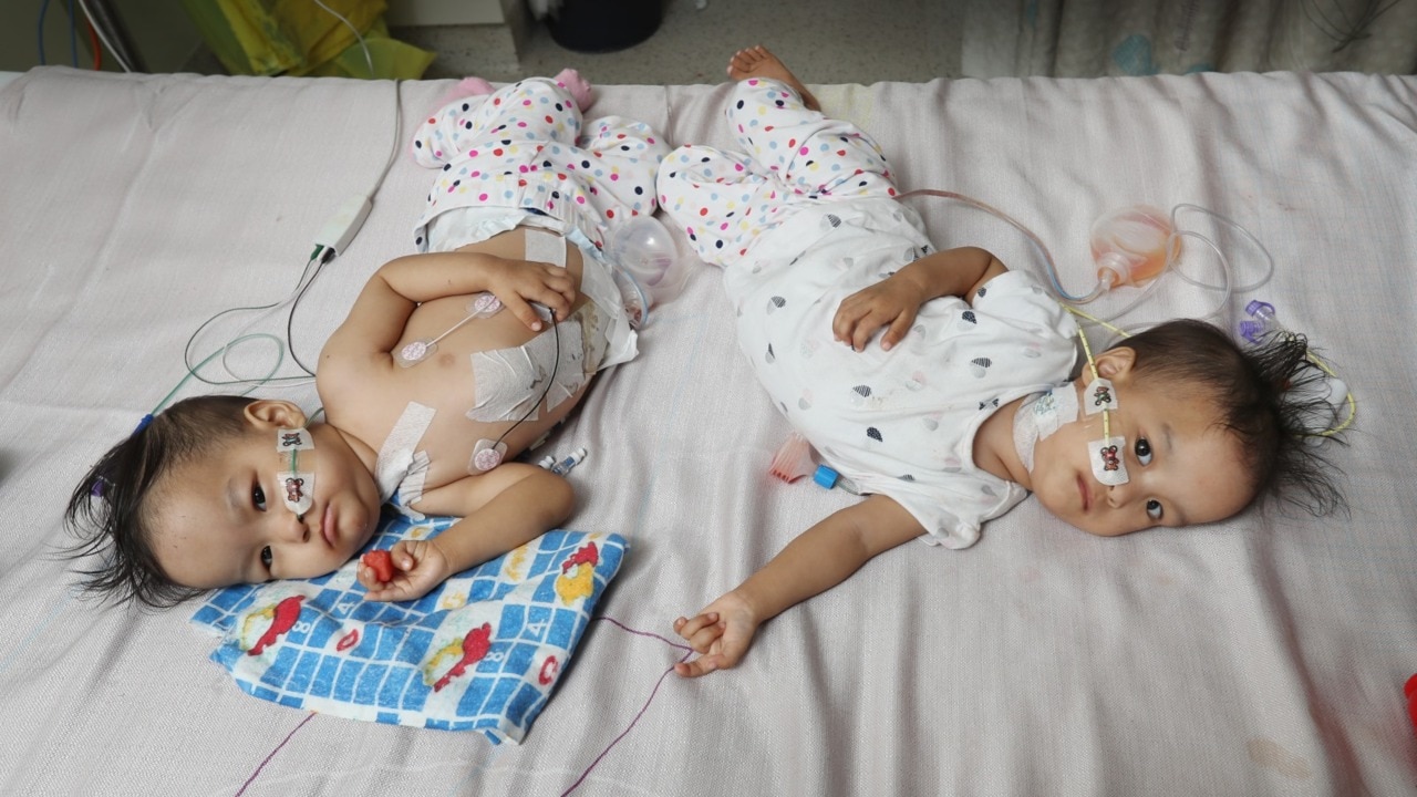 Conjoined twins successfully separated : Year in Review