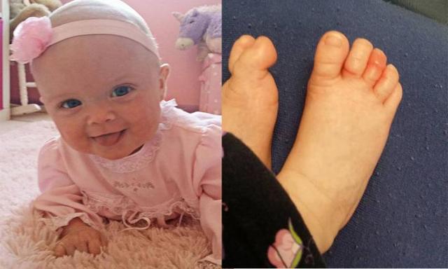 Household item used to save baby's toes after hair became tangled