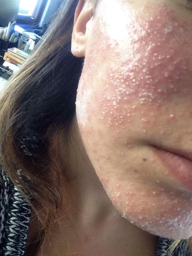 Katy Hull developed an infection to her face after getting eyelash extensions at a Ringwood salon.